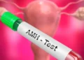 An Overview of Anti-Mullerian Hormone Test